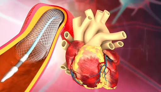 What to Expect Before, During, and After Angiography in Nagpur?